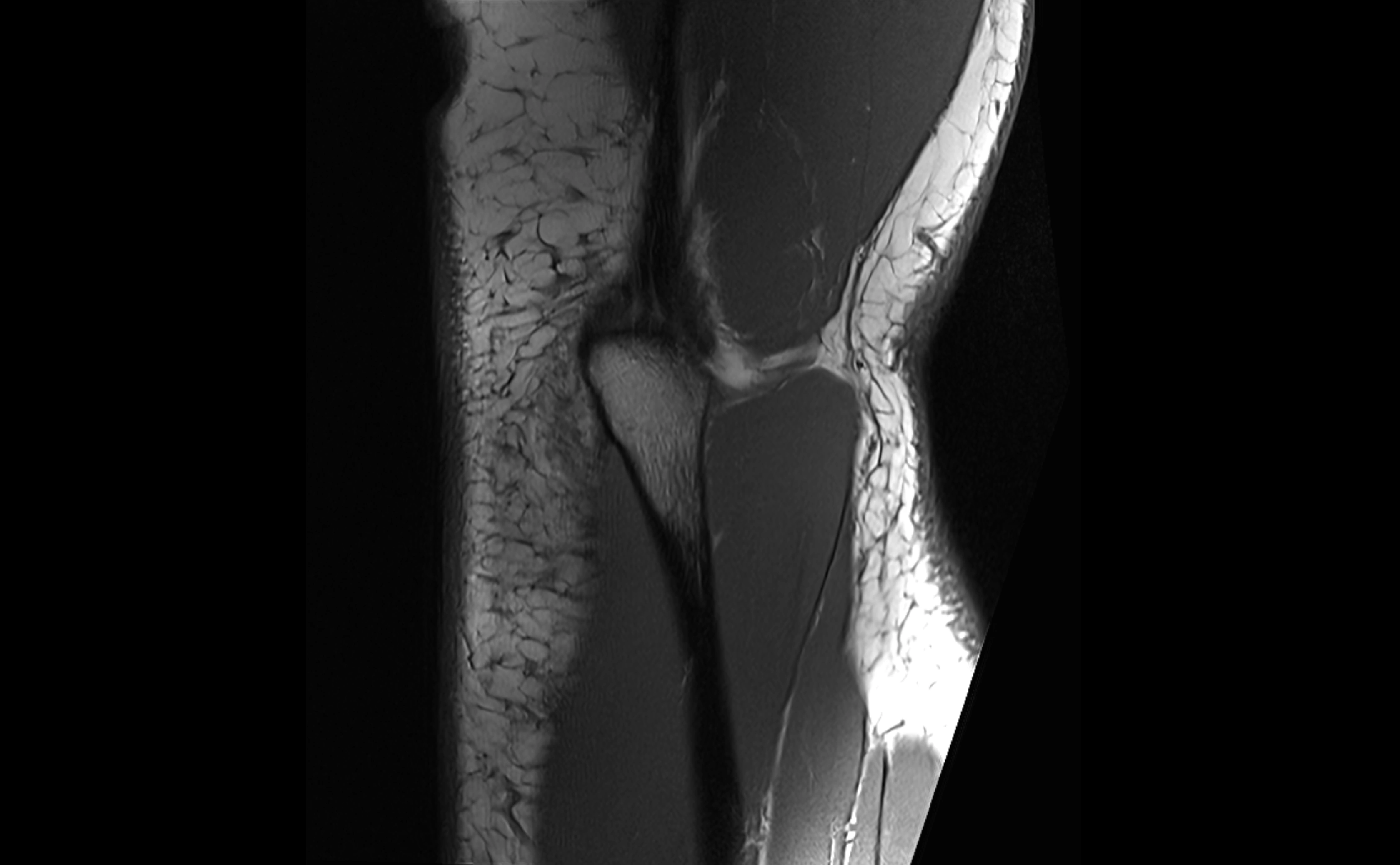 MRI elbow ligaments coronal cross sectional anatomy 3T  radiology  image-img-07001-00029.webp